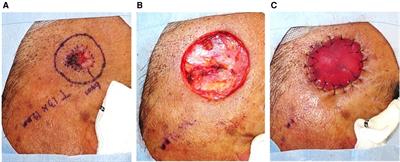 Retrospective evaluation of the utility of two-step surgery for facial basal cell carcinoma and squamous cell carcinoma